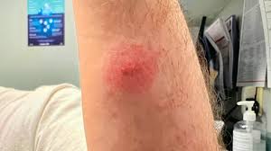 hyperthermie borreliose