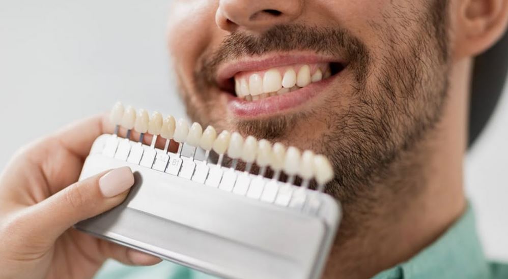 dental veneers