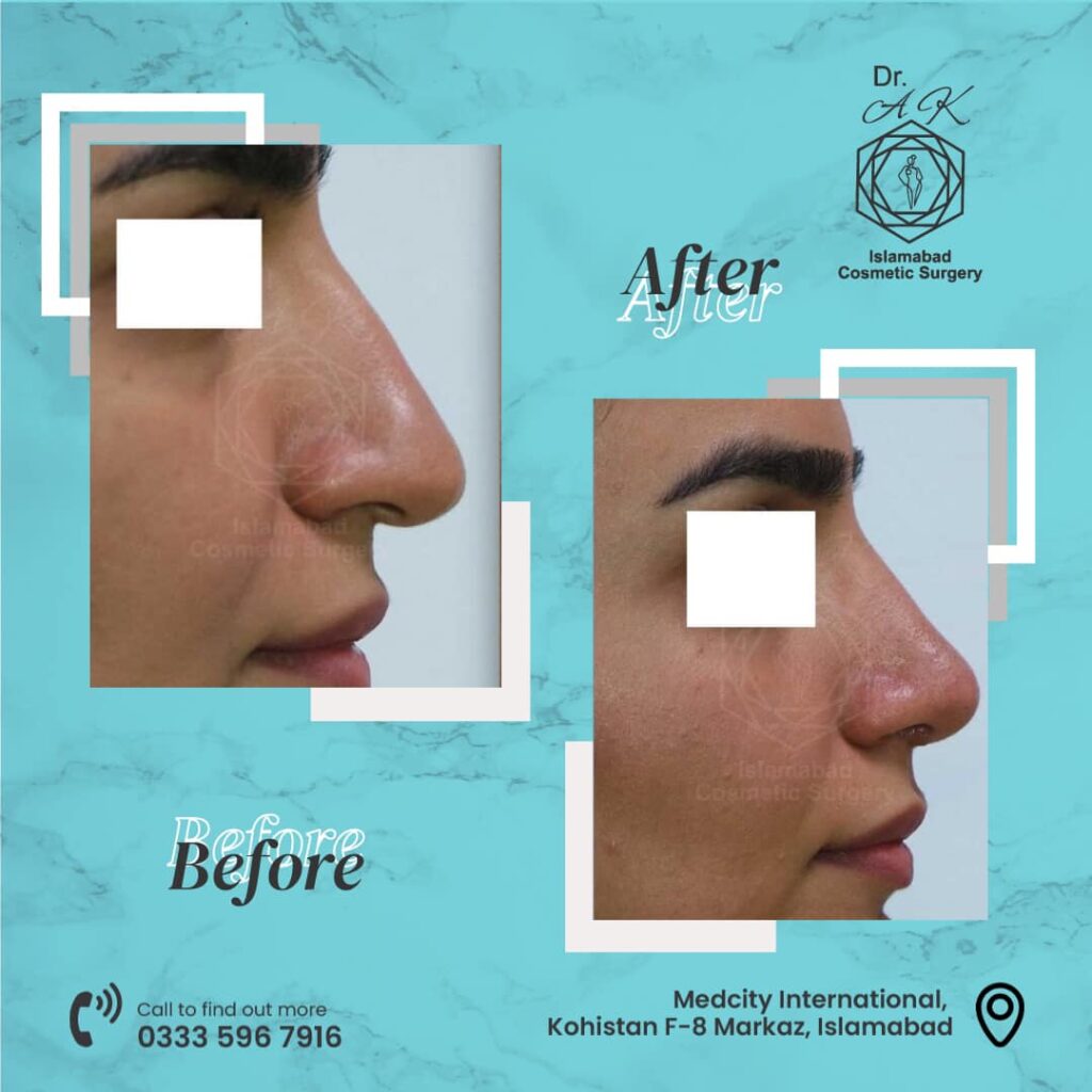 rhinoplasty in islamabad