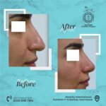 rhinoplasty in islamabad