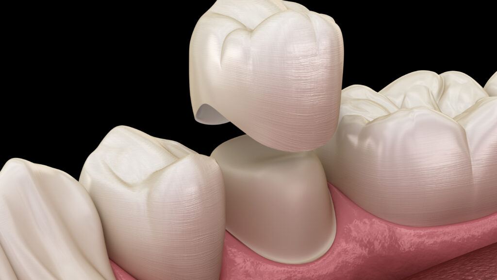 Dental Crowns Explained When Does a Damaged Tooth Need More Than a Filling