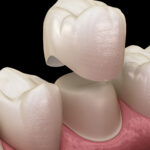Dental Crowns Explained When Does a Damaged Tooth Need More Than a Filling