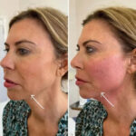 Endolift Treatments in Dubai for Natural Facial Contouring and Rejuvenation