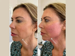 Best Plastic Surgeons in dubai for Endolift Facial Tightening Techniques