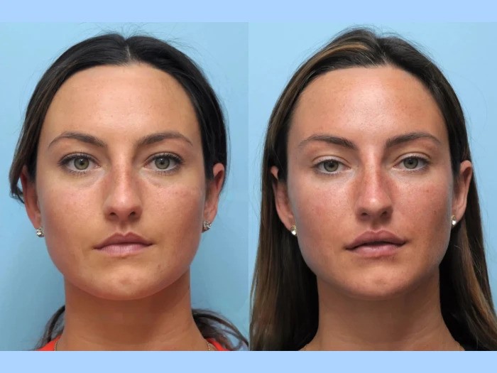 Best Aesthetic Clinic in Dubai for Natural Youthfulness Through Thread Lift Treatment