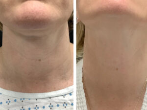 Best Plastic Surgeons in dubai for Radiofrequency Microneedling Skin Smoothing