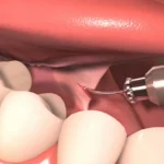 What Is a Frenectomy Understanding This Common Oral Procedure